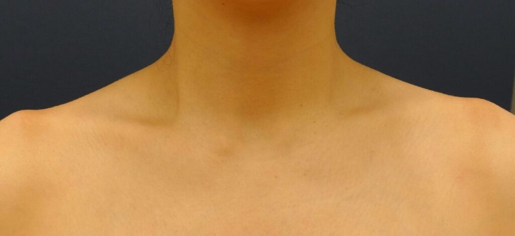 ～効果～ 肩こり緩和、改善 肩ラインの盛り上がりの改善 首が長く見える効果