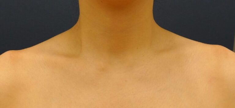 ～効果～ 肩こり緩和、改善 肩ラインの盛り上がりの改善 首が長く見える効果